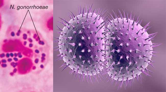 Neisseria gonorrhoeae - Vi khuan gay benh lau
