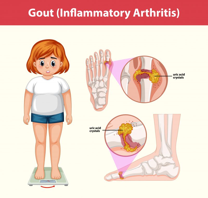 Bệnh Gout là bệnh gì. Triệu chứng, Nguyên Nhân, Cách Điều Trị Gout.